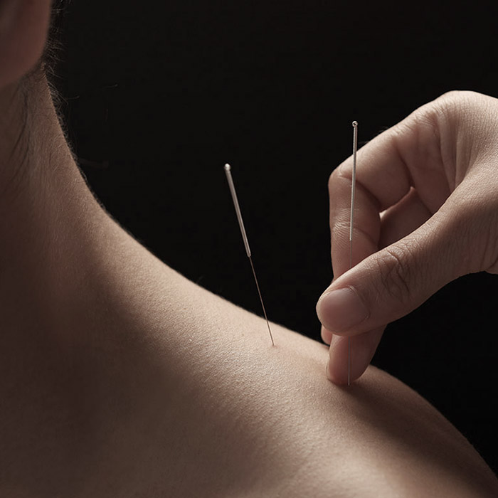 Acupuncture